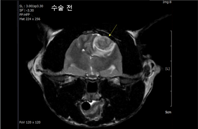 원 내 MRI 검사로 확인된 뇌수막종 사진1