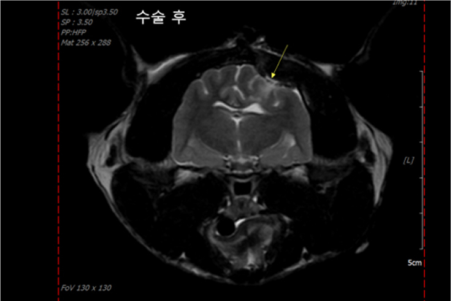 원 내 MRI 검사로 확인된 뇌수막종 사진2